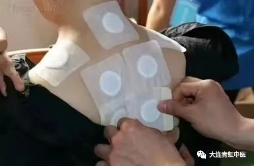 用麝香做药引的三伏贴，你见过吗？